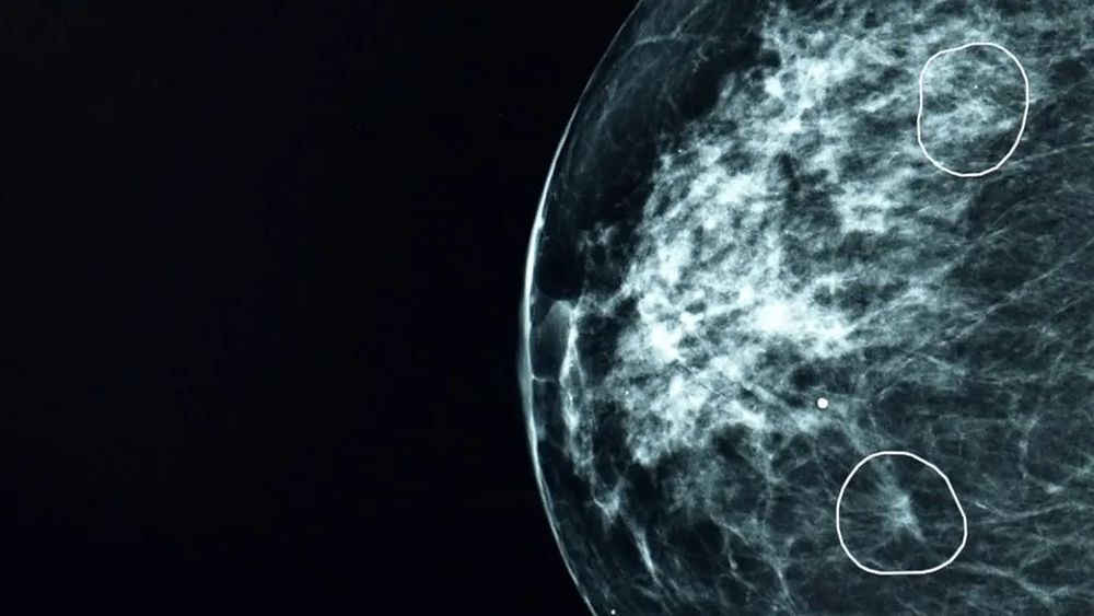 AI Tool Spots Tiny Cancers Missed by Doctors