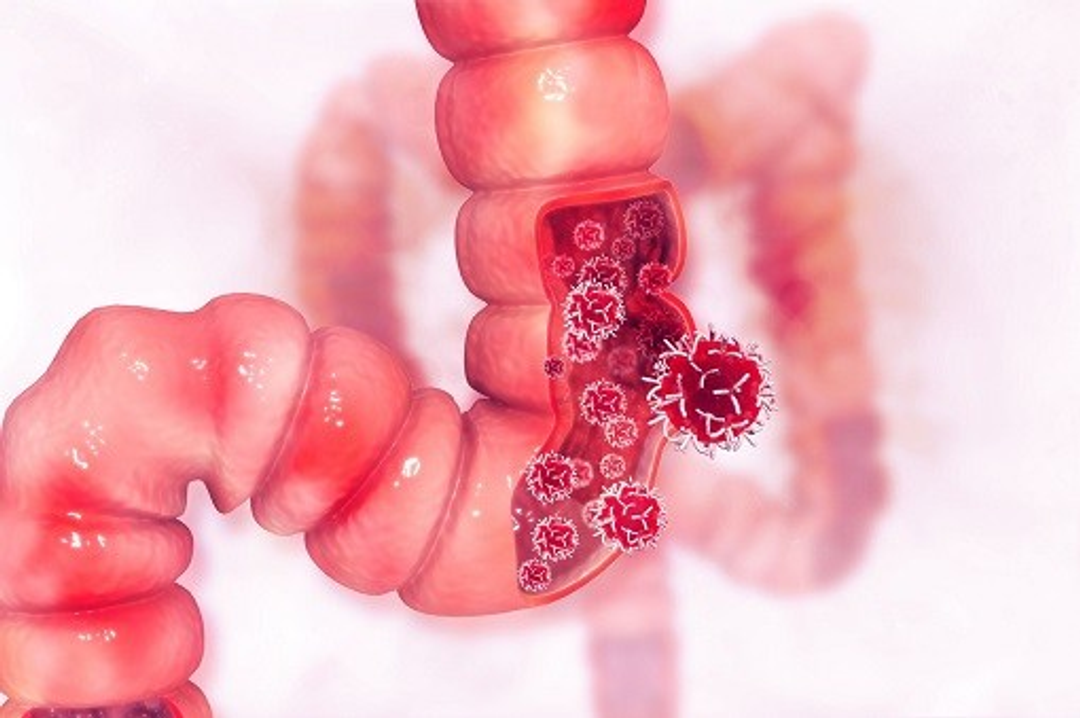 a computer generated image of a colon with bacteria growing on it .