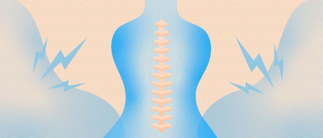 Comic stylized image of a back with the spine outlined, sharp blue lightning bolts to represent pain radiating on both sides of the body, all on a cream coloured background