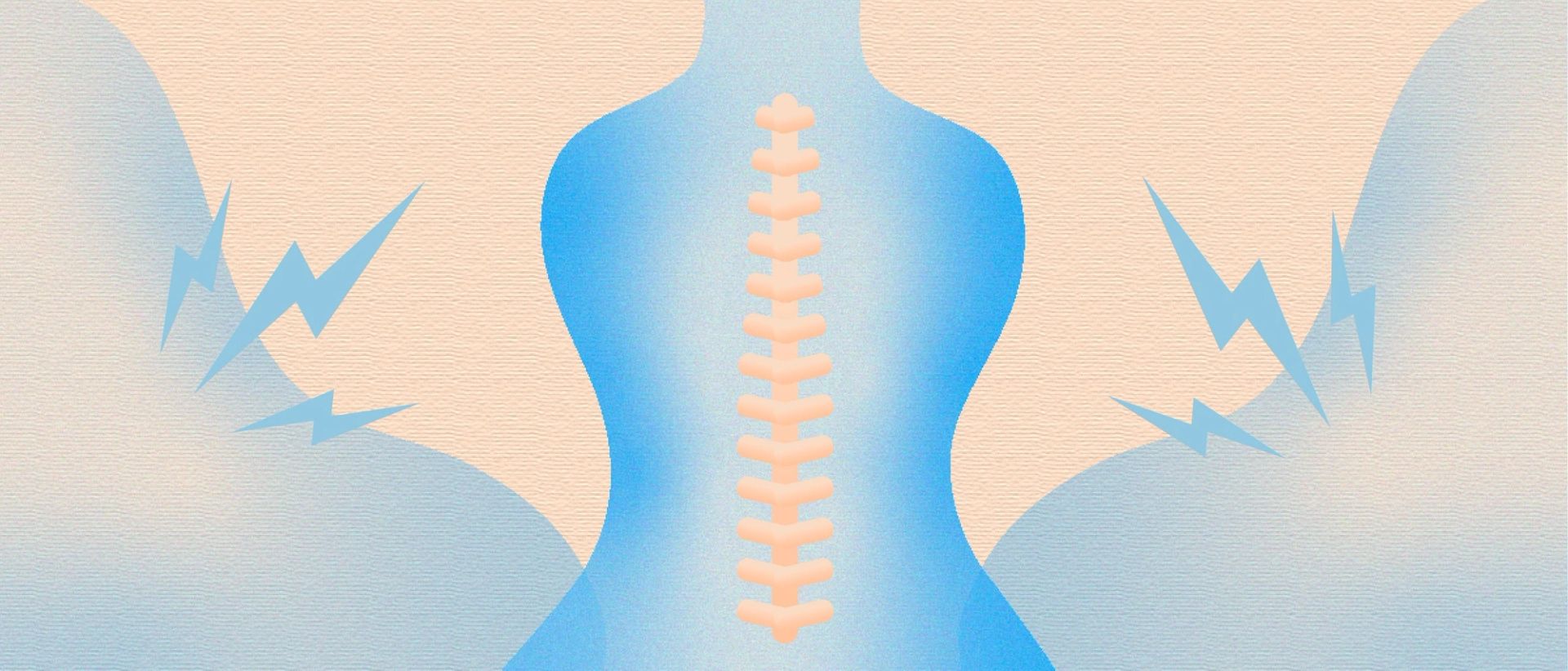 Comic stylized image of a back with the spine outlined, sharp blue lightning bolts to represent pain radiating on both sides of the body, all on a cream coloured background