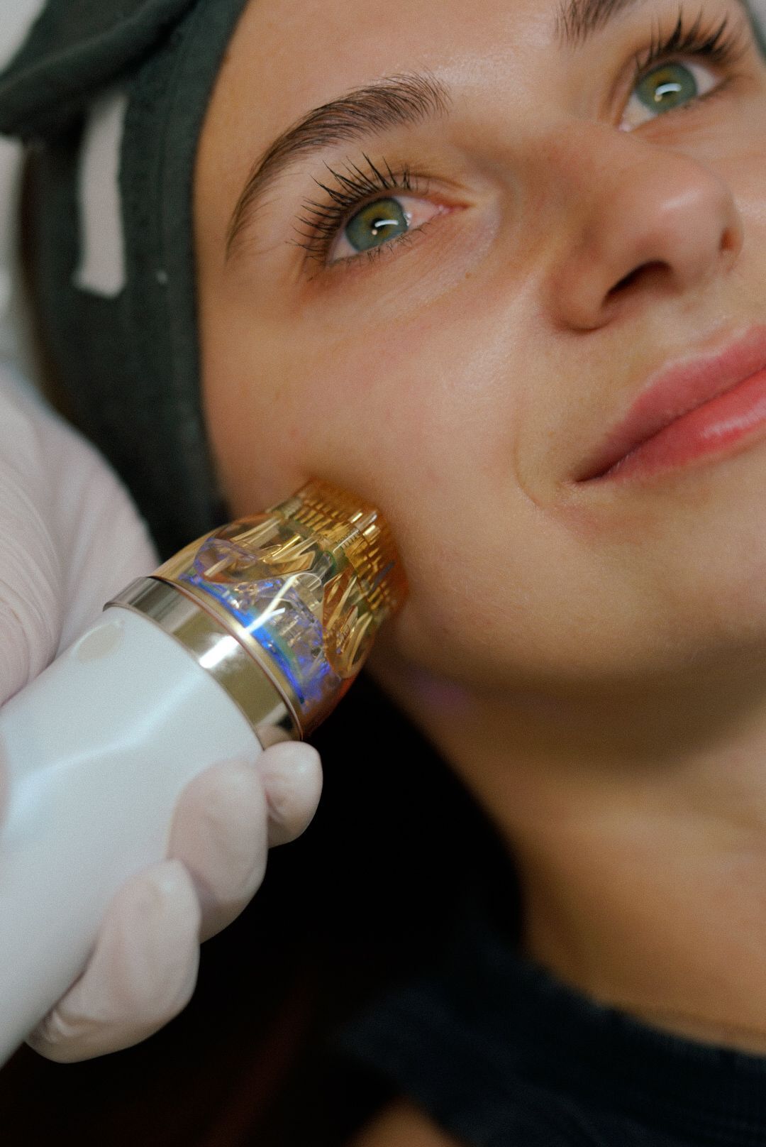 МІКРОГОЛКОВИЙ ЛІФТИНГ ОБЛИЧЧЯ+ШИЯ