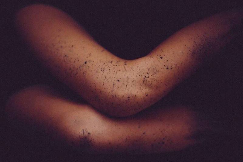 Top Clinical Insights: Treatment of Psoriasis in Special Locations