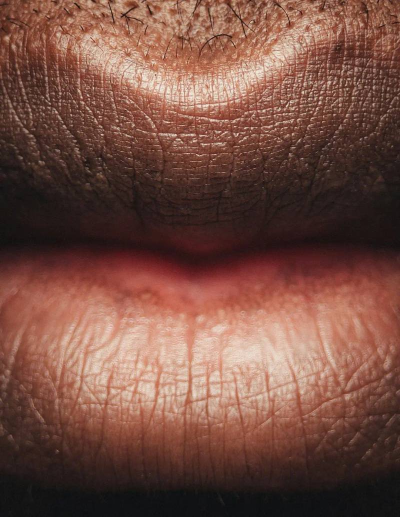 Angioedema and Urticaria