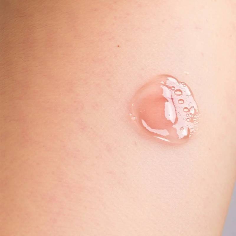 Video Blog: Difficult Cases Learned in Blistering Diseases