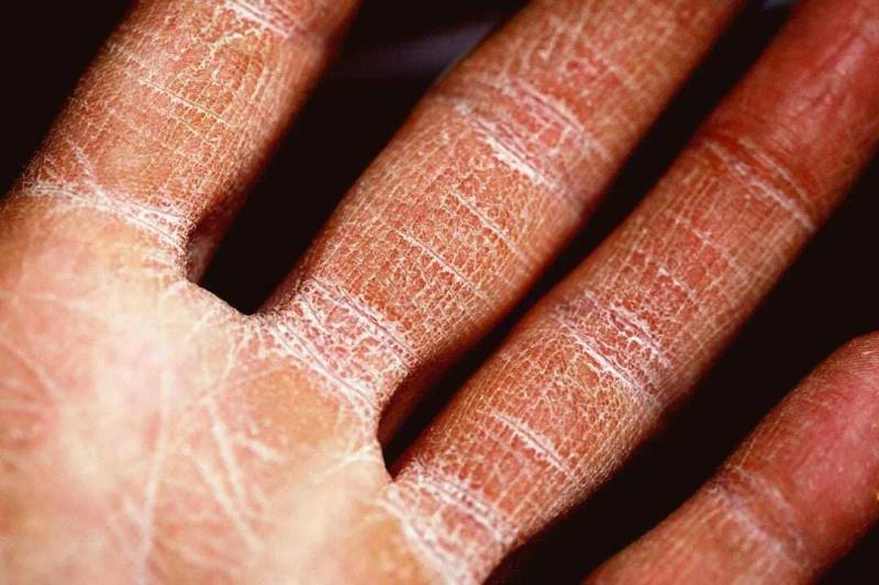 Summary of NEMLUVIO in Atopic Dermatitis