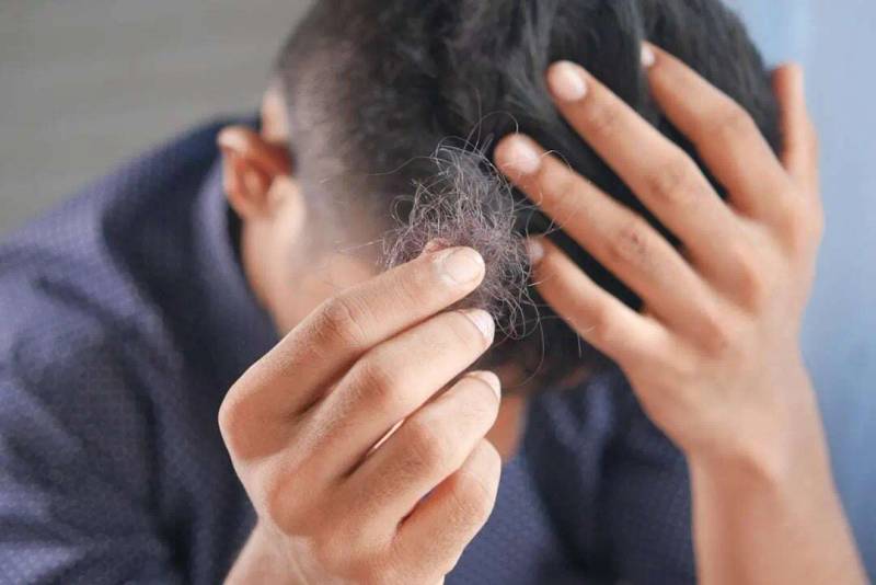 Oral Minoxidil: Therapeutic Guidelines