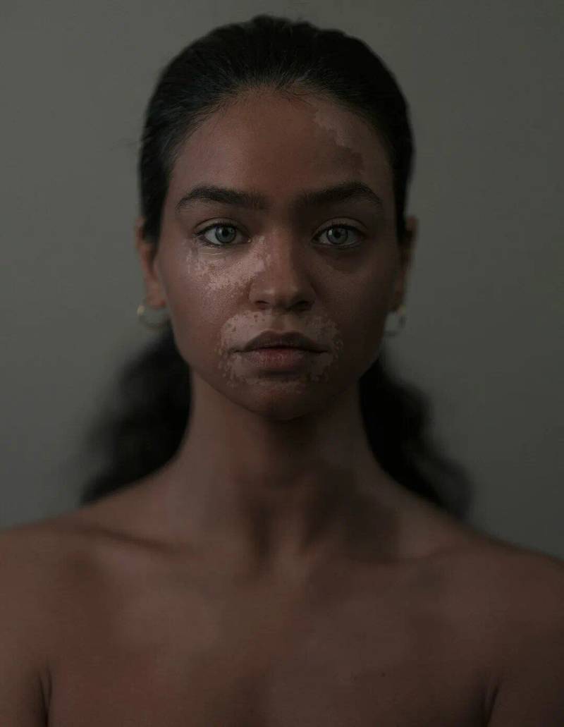 Vitiligo Updates