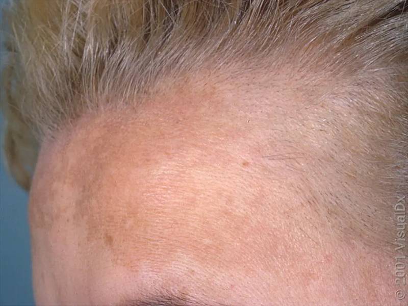 Video Blog: Updates in Hyperpigmentation