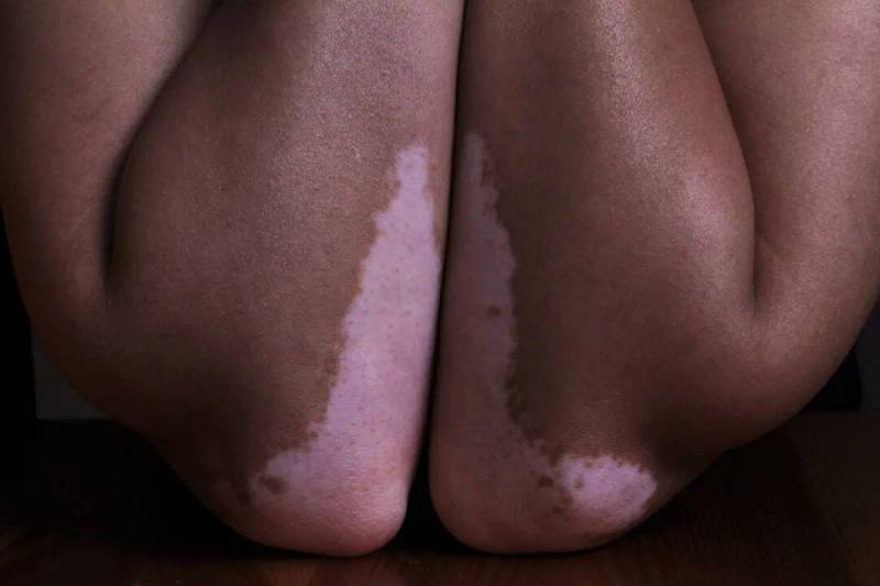 Vitiligo Therapy: Current and Future Treatments