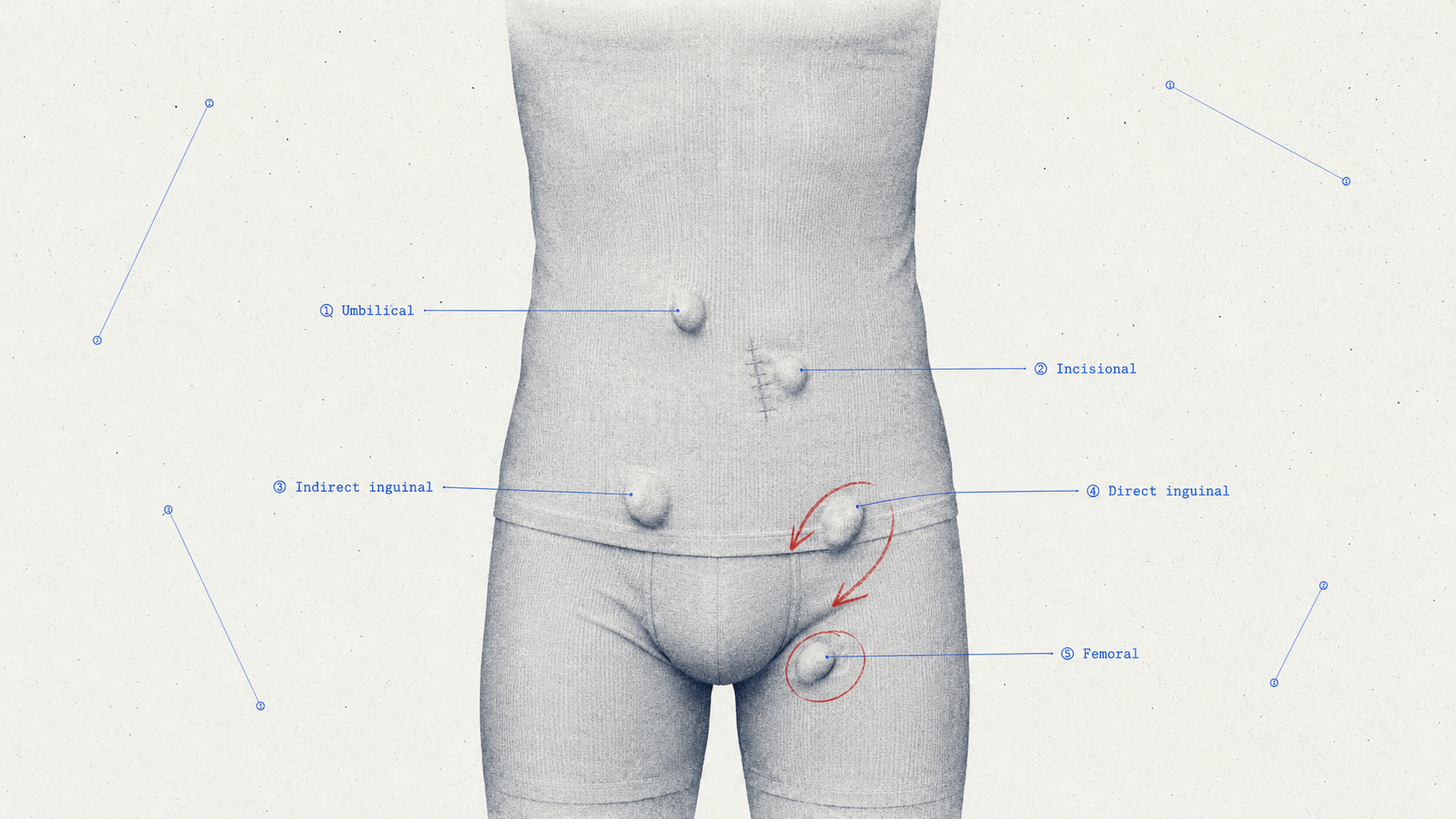 Hernia Types and Classification for NEET PG