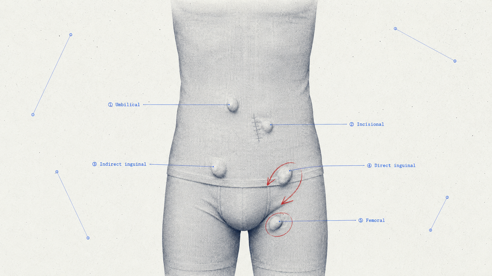Hernia Types and Classification for NEET PG