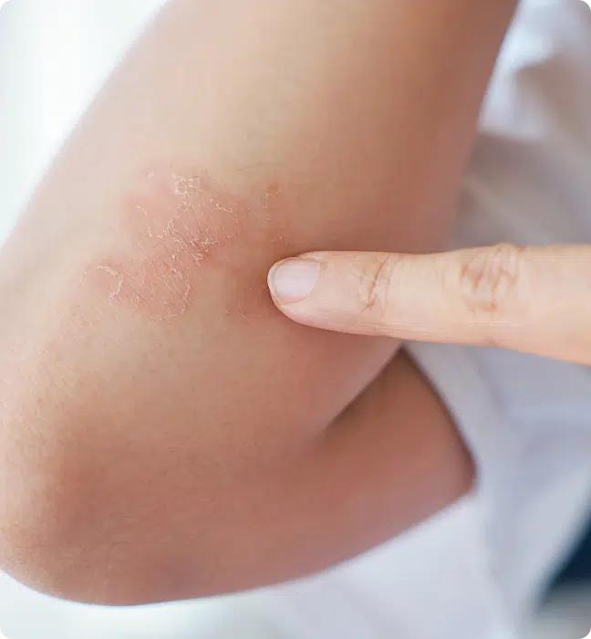 Psoriasis Treatment Online in Ireland, Psoriasis Treatment in Ireland We Understand What Youre Going Through