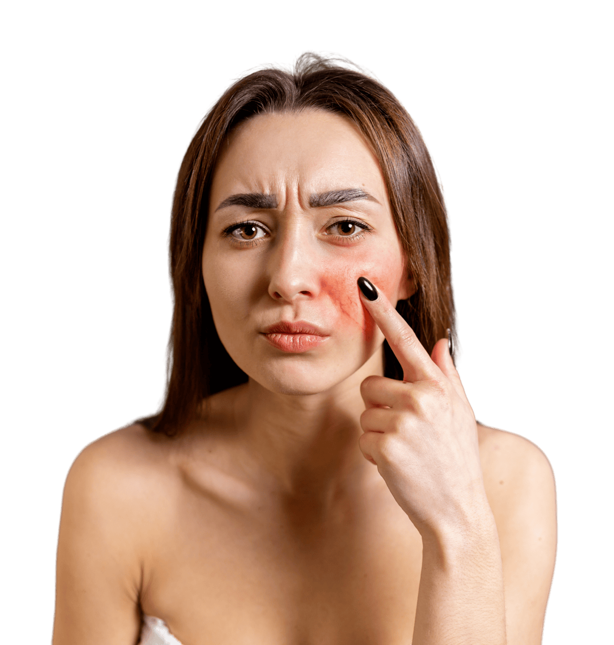 Rosacea Treatment in Ireland