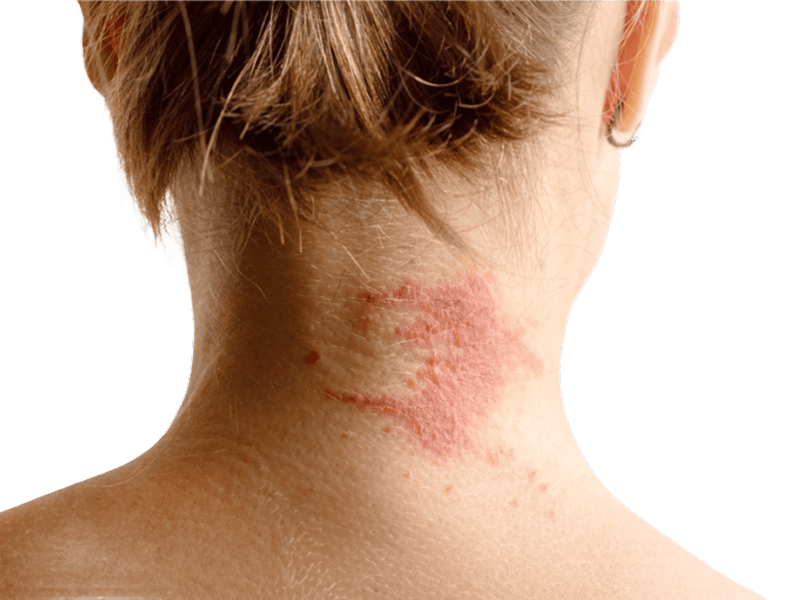 Eczema Treatment Online in Ireland