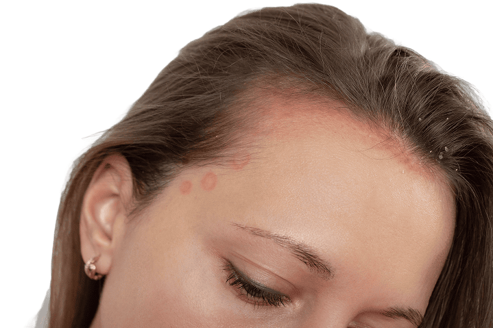 Psoriasis Treatment Online in Ireland