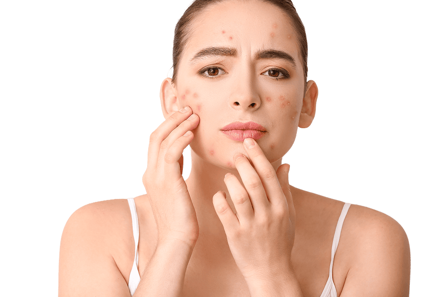 Acne Treatment Ireland, Topical & Oral Prescriptions Online