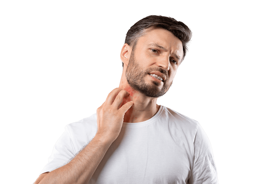 Shingles Treatment Online in Ireland