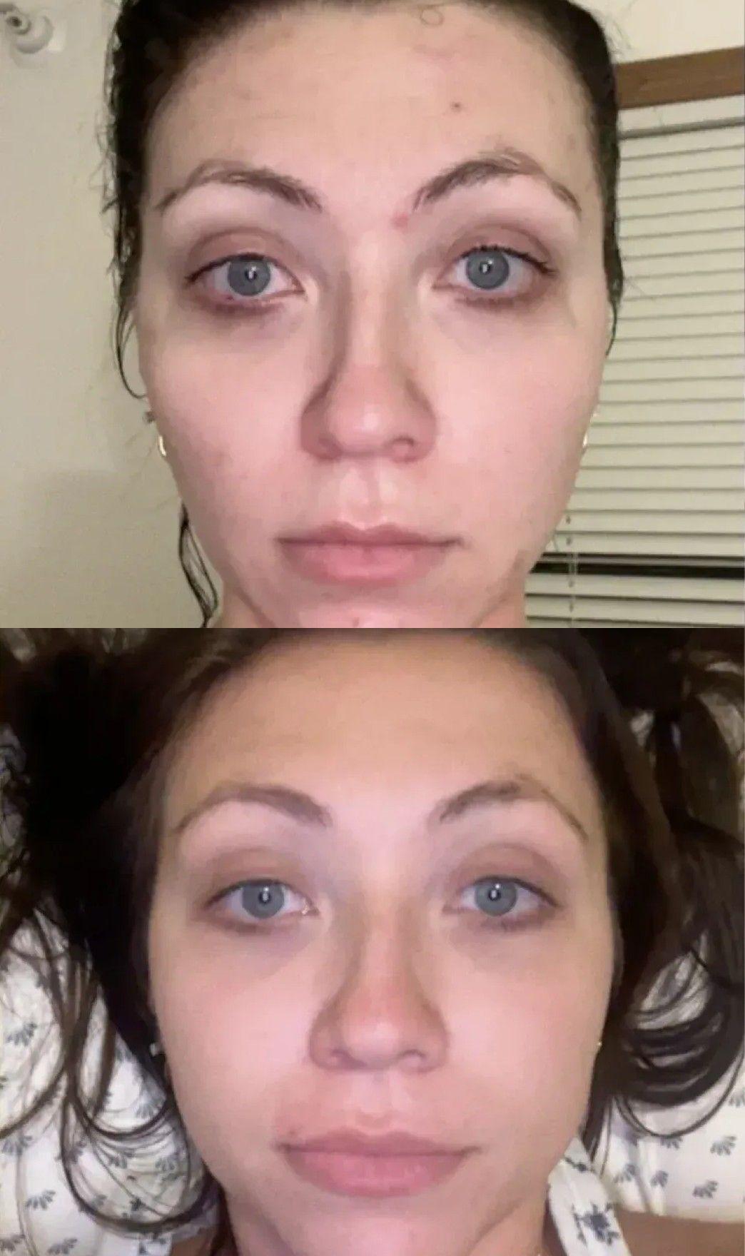 Nolla Derm patient before and after