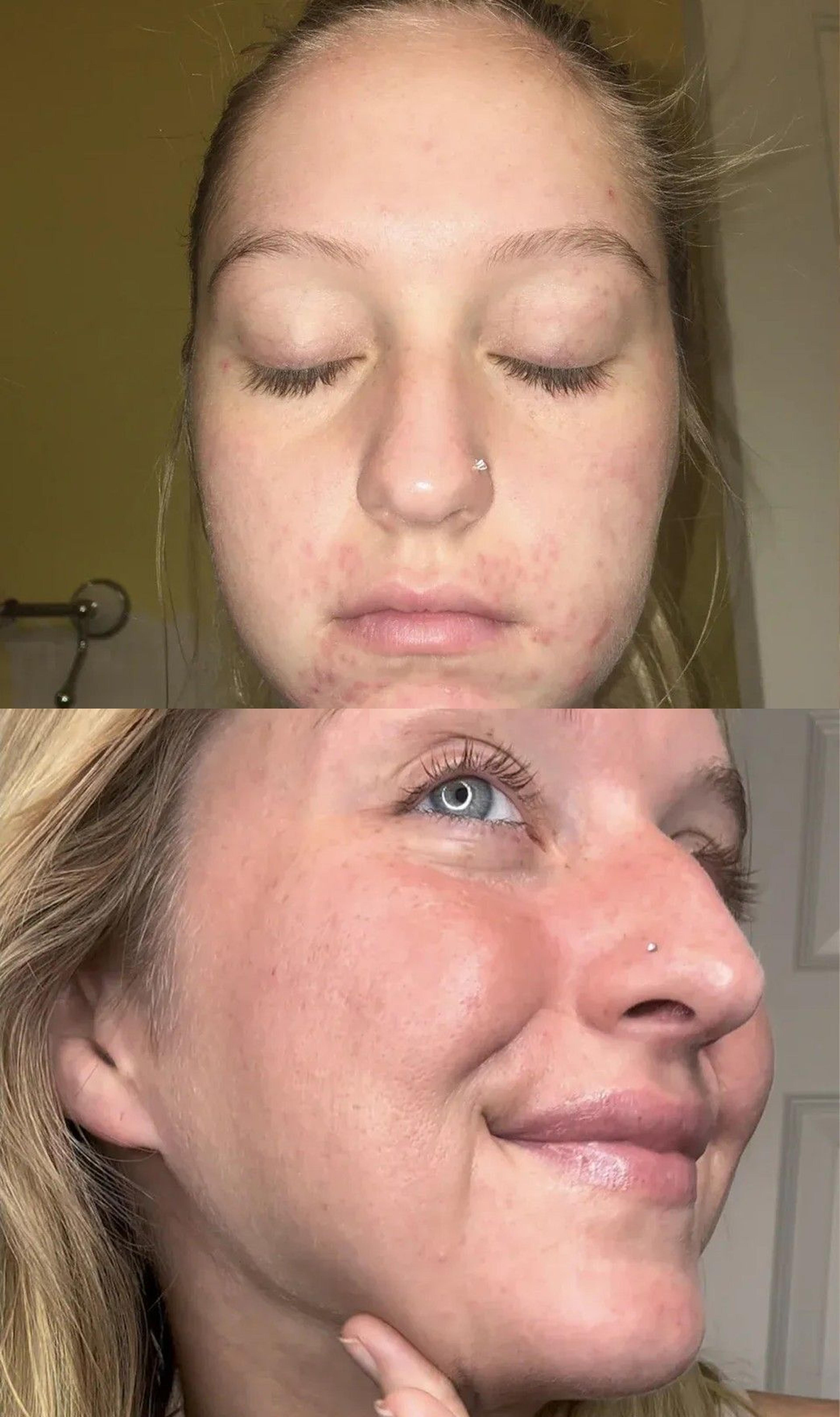 Nolla Derm patient before and after