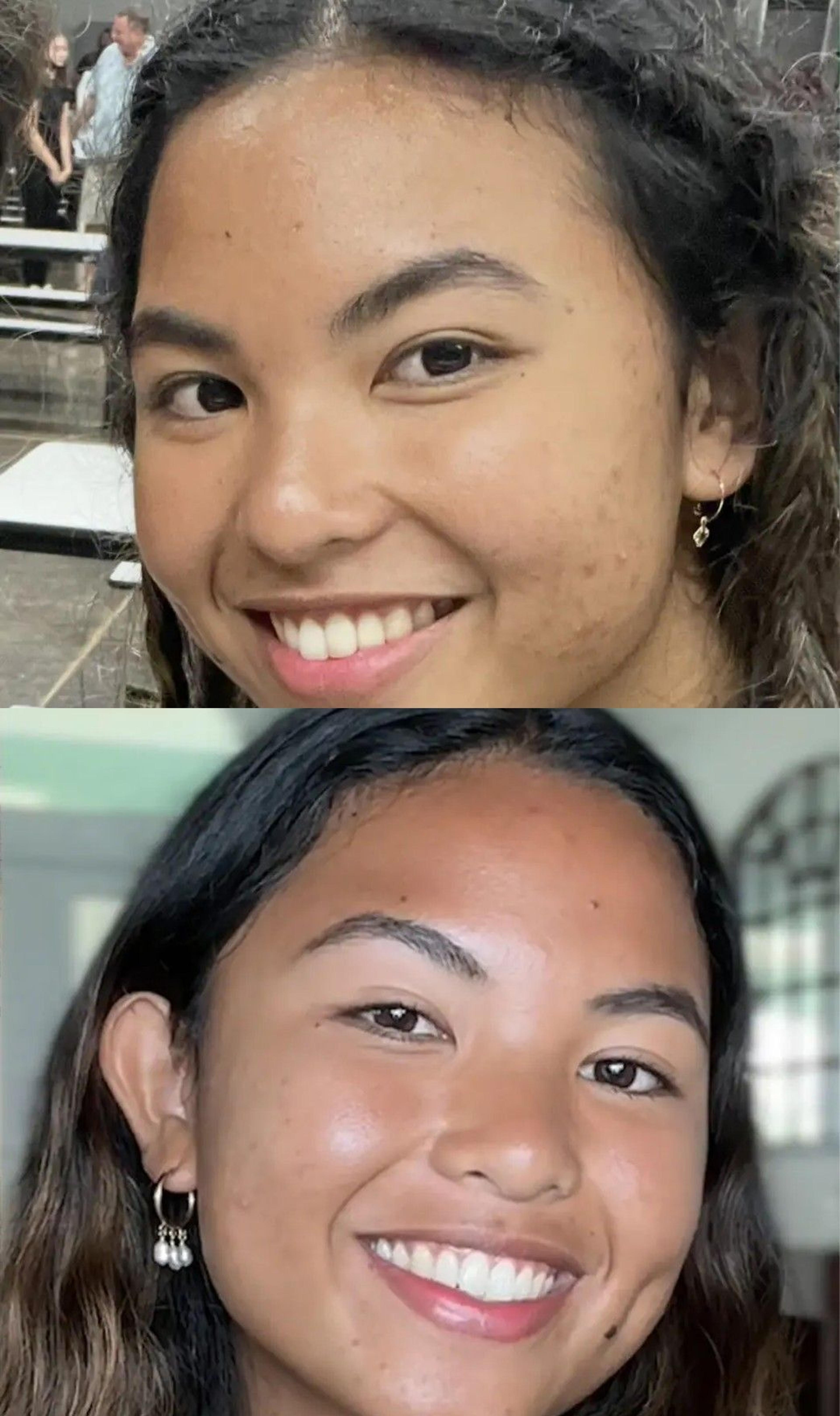 Nolla Derm patient before and after