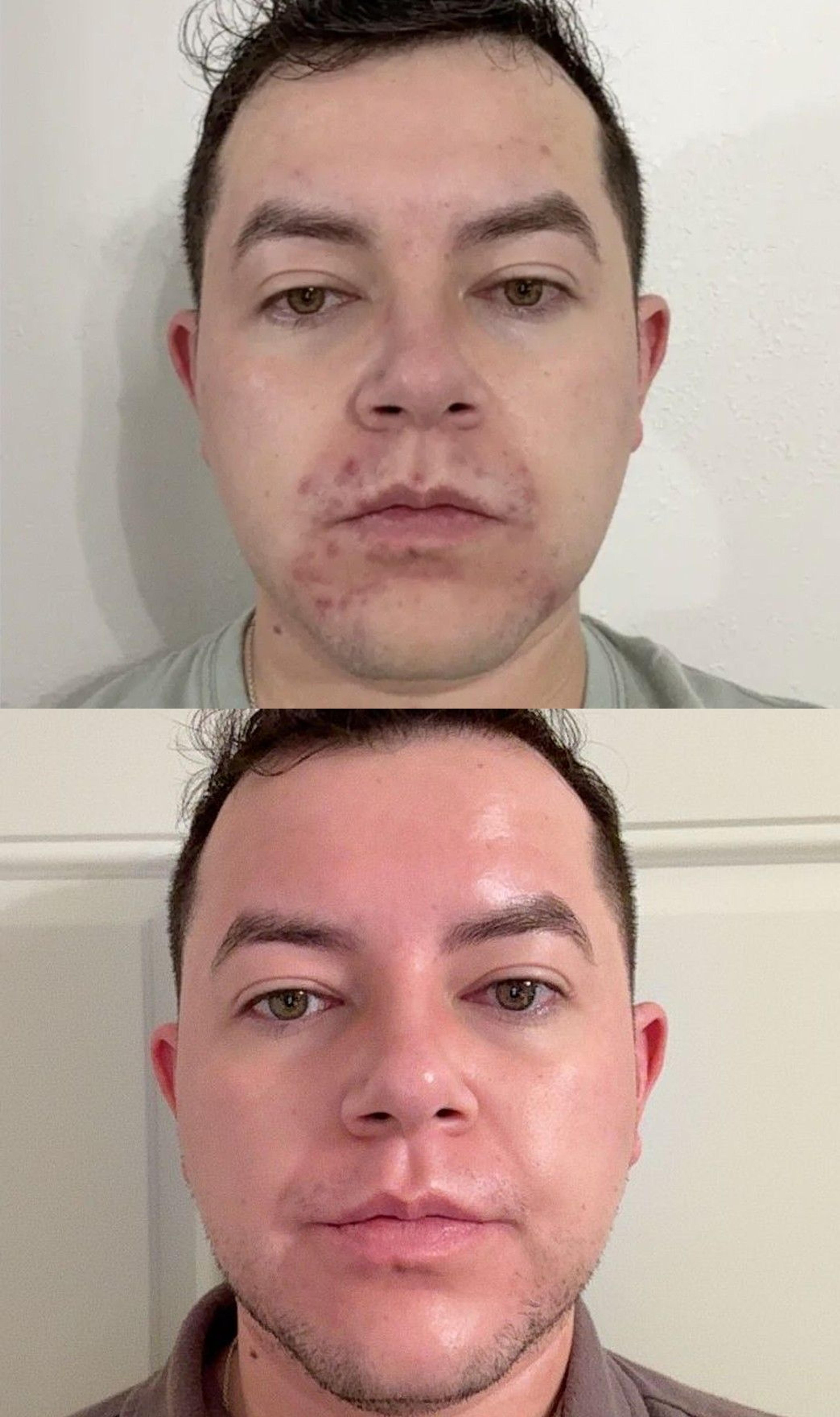 Nolla Derm patient before and after