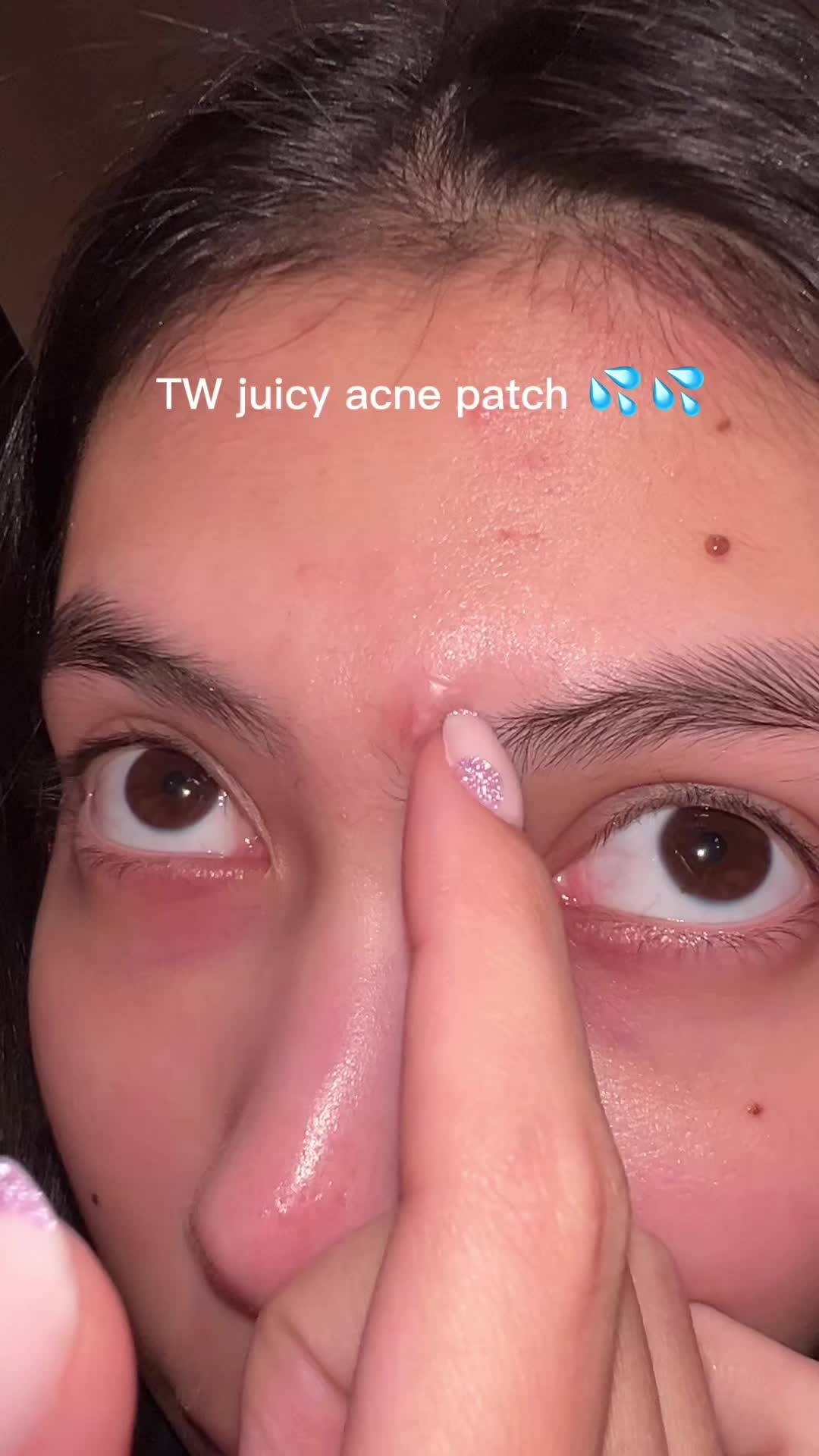 Chloé Gervais: OK c’est confirmé @HeroCosmetics.FR c’est vraiment les meilleurs patchs d’acné 😭😭😭…
