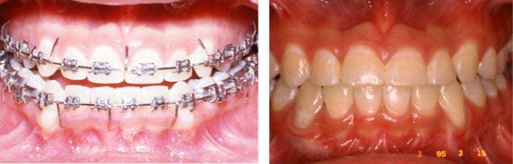 Close-up photos of the young man's teeth, before and after. 