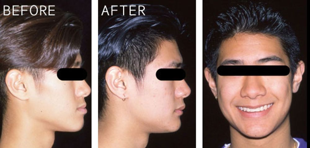 Case 1 Before and After Photo of a young man with his bite line corrected. 