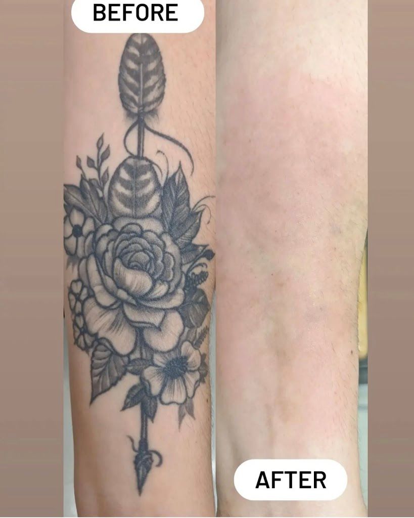 Bonsai Tattoo Removal Rowlett