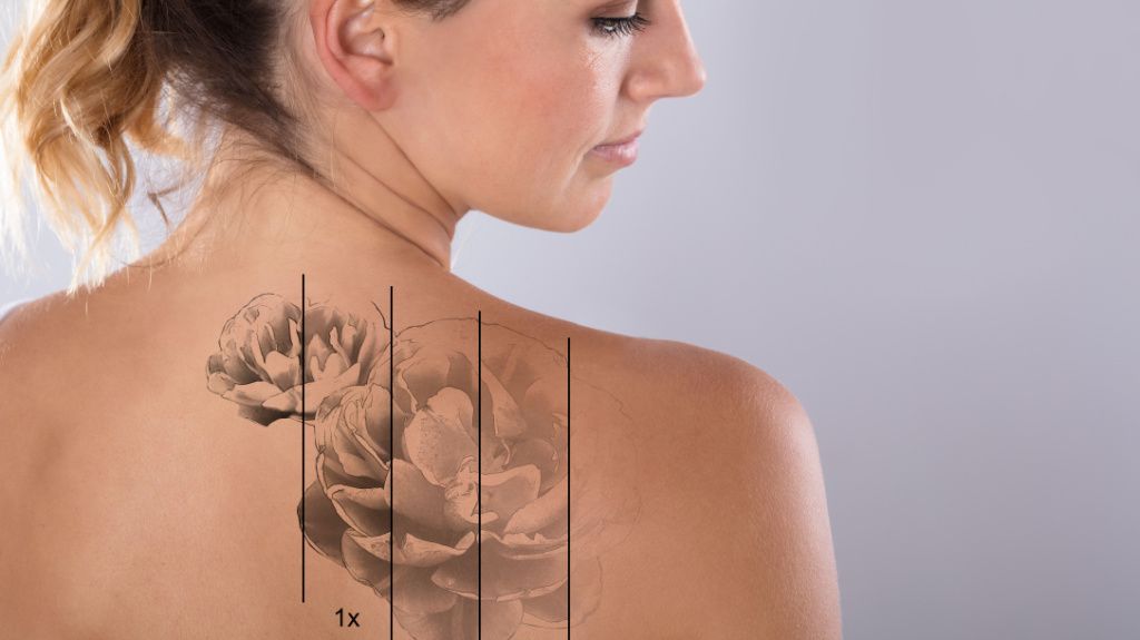 Laser Eraser: Laser Tattoo Removal - Clark