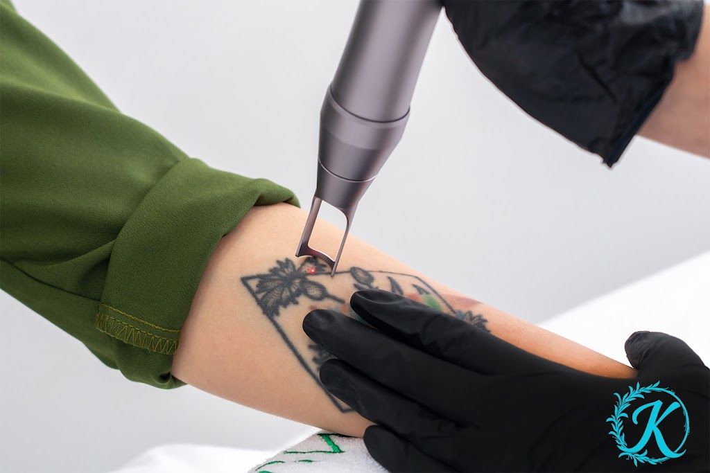 Keepsake Laser Tattoo Removal