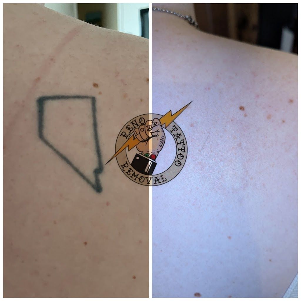 Reno Tattoo Removal