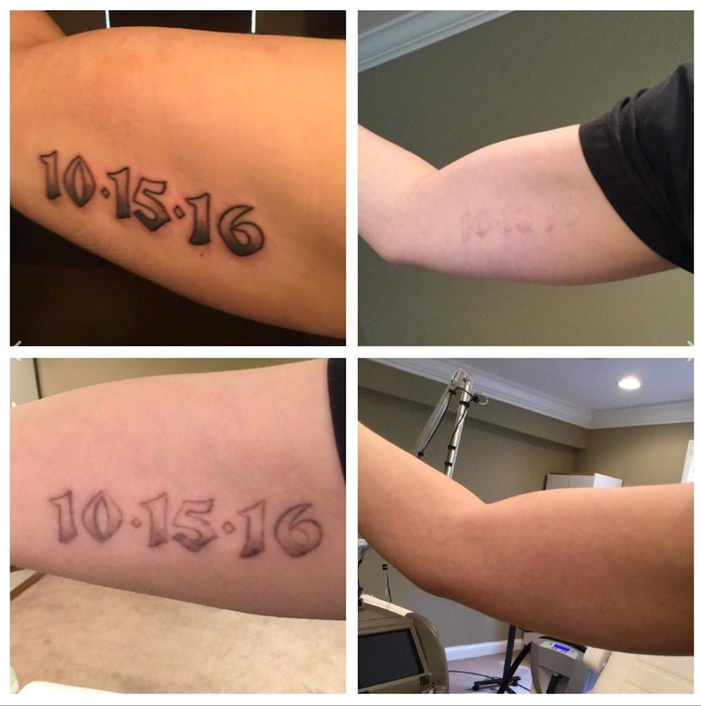 Lexington Tattoo Removal