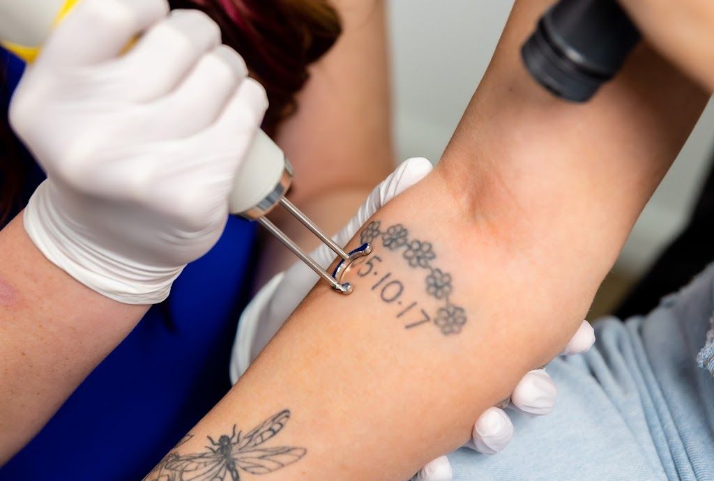 NEO Tattoo Removal & Fading