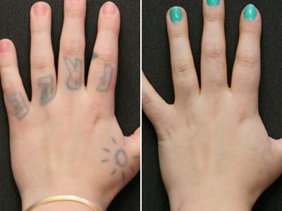 Anticipation Tattoo Removal