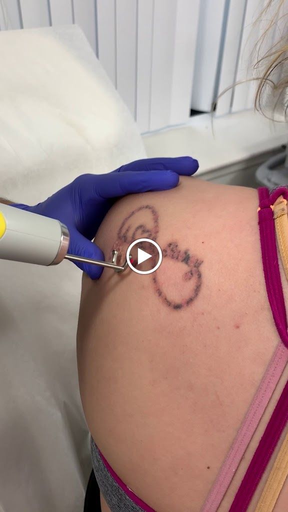 MD Laser Tattoo Removal Baltimore