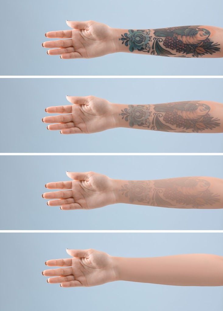 Tattoo Removal Project by OTM