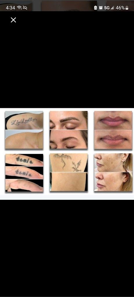 Grand Rapids Tattoo Removal