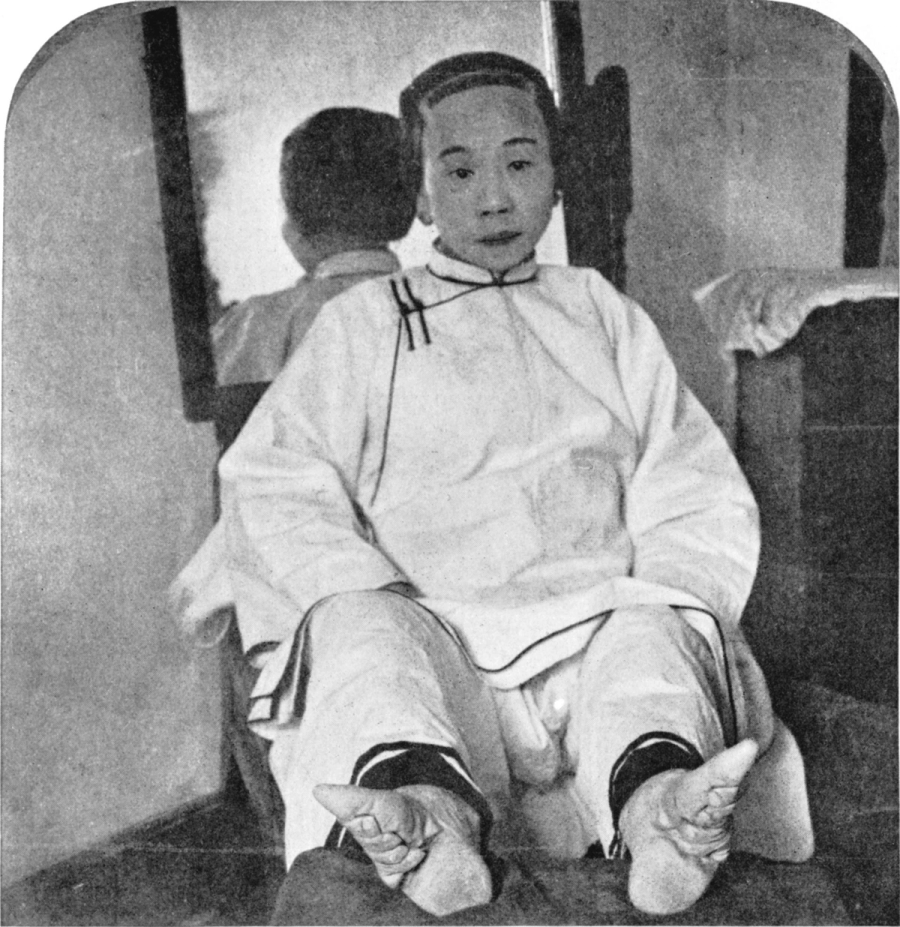 Jente med snørte føtter - en skikk som ble utført på jenter og kvinner i Kina i ca tusen år. Foto: Women Of All Nations.