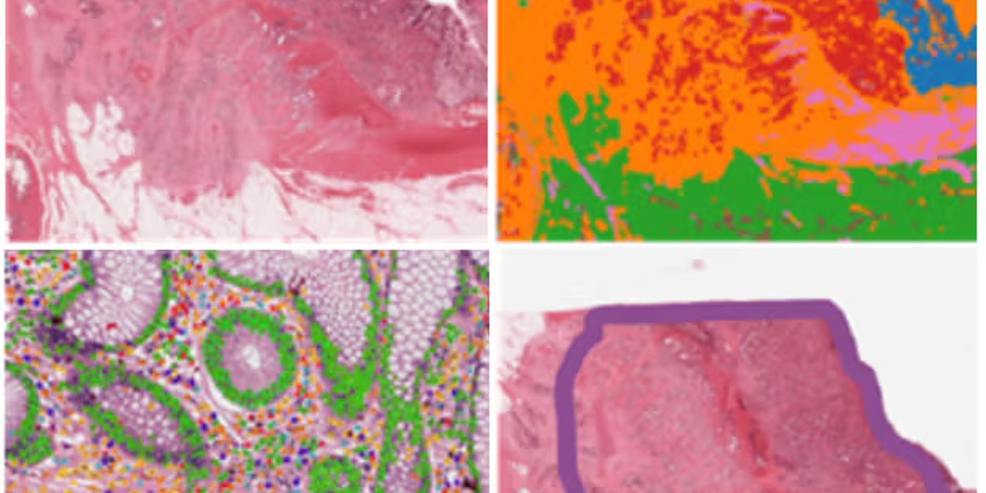 Tumour Stroma Ratio