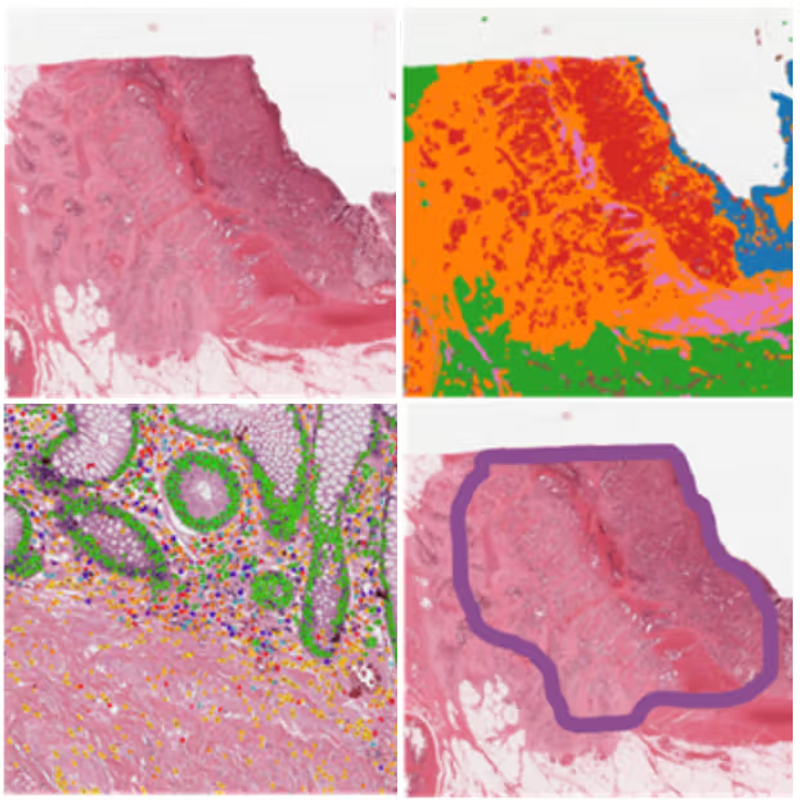 Tumour Stroma Ratio
