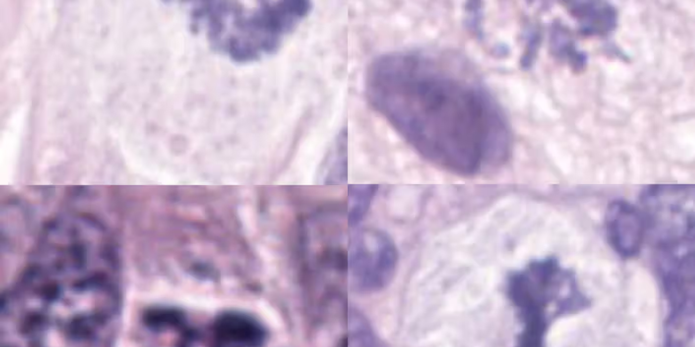 Atypical Mitoses
