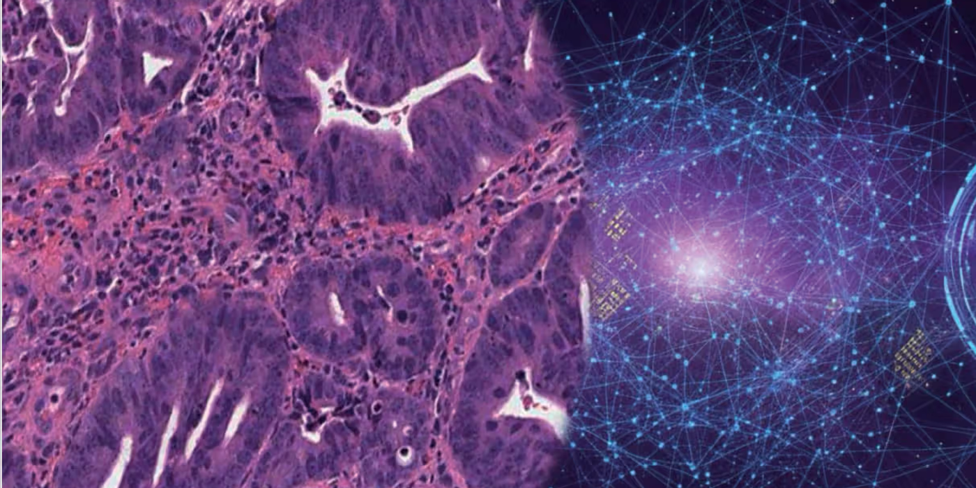 AI tool helps predict treatment success in rectal cancer patients
