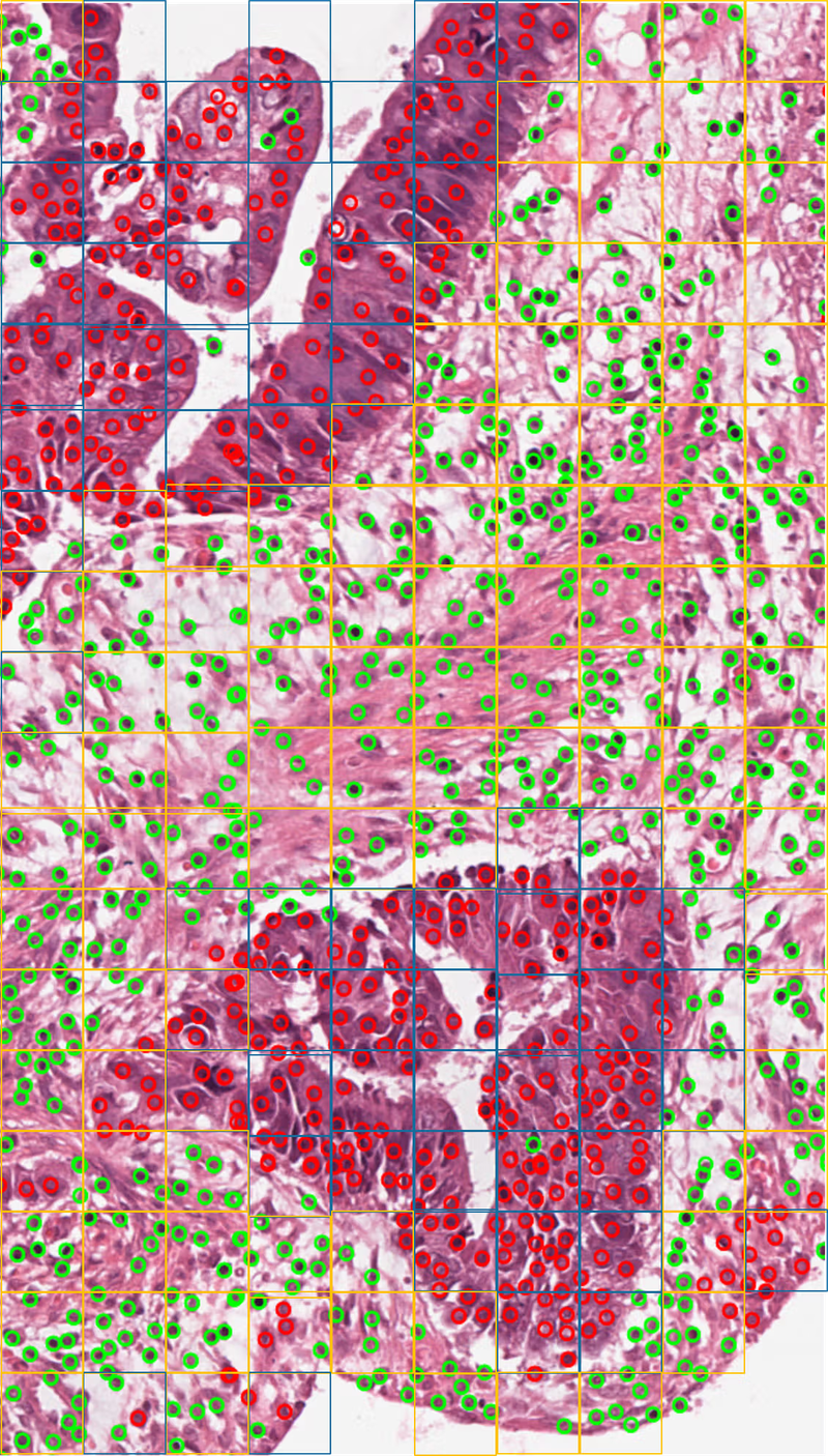 Tumour Cell Density