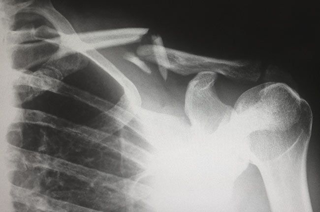 X-Ray Showing Broken Collarbone | IDID Radiology