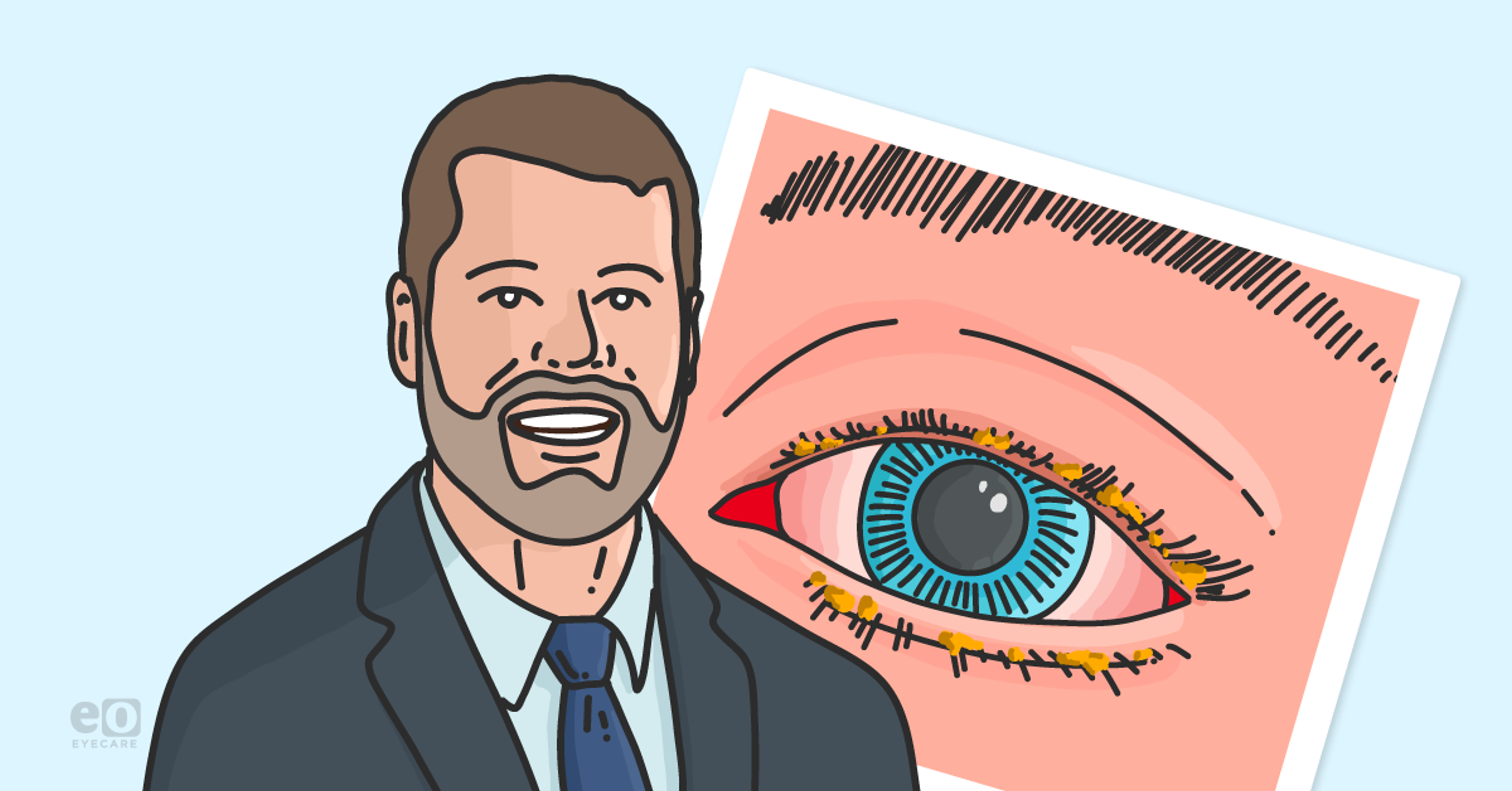 Glandular Dysfunction: Demodex and MGD