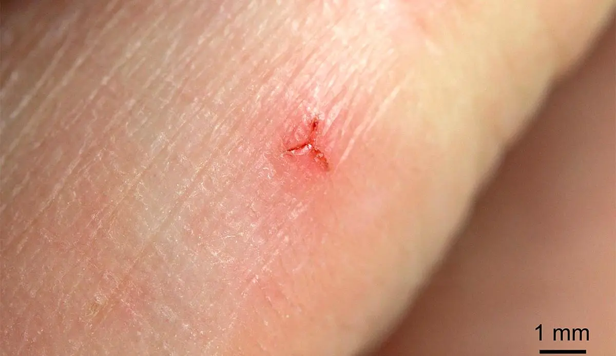 the mark a leech leaves on someone_s skin