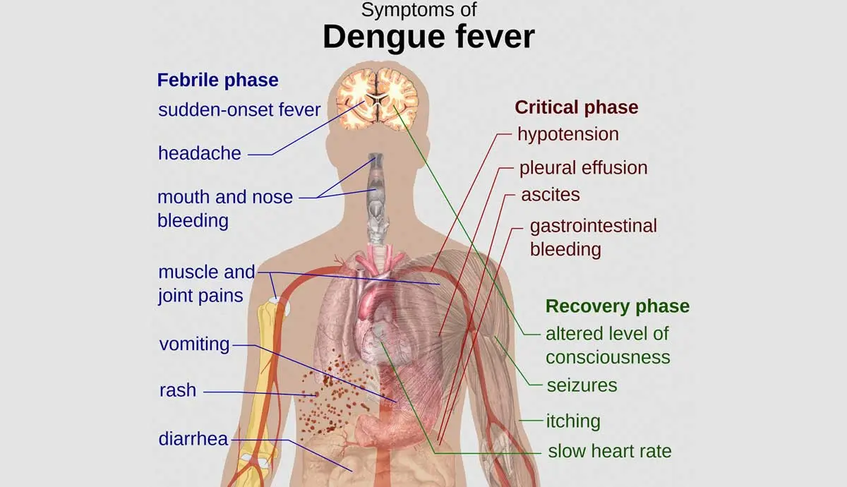 dengue fever symptoms after mosquito