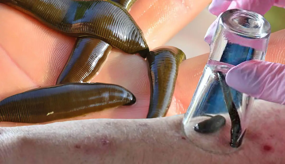 do leeches help with health problems