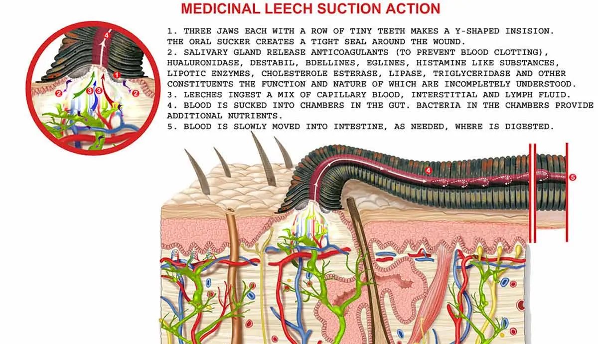 a diagram on how leech therapy works